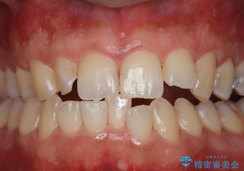 妻に歯医者へ行くよう言われて来院の症例 治療後