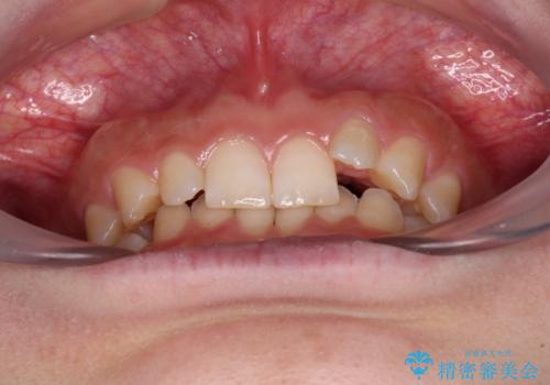 ディープバイトを短期間で改善 ワイヤー矯正治療の治療前