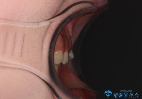 ディープバイトを短期間で改善 ワイヤー矯正治療の治療前