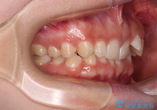 ディープバイトを短期間で改善 ワイヤー矯正治療の治療前