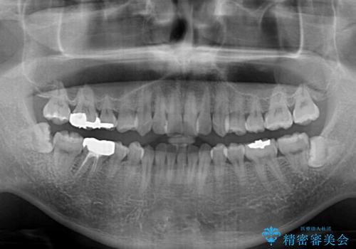 前歯のデコボコと突出感をマウスピース矯正できれいにの治療前