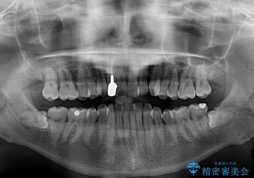 前歯のデコボコを治したい インビザラインによる矯正治療の治療前