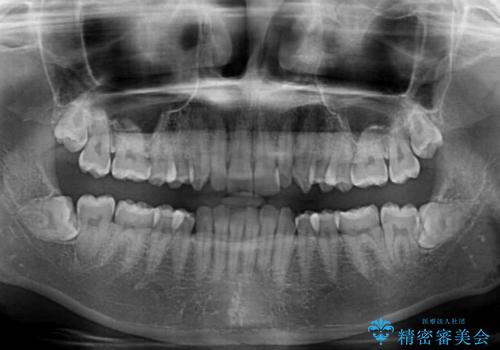 ディープバイトを短期間で改善 ワイヤー矯正治療の治療前