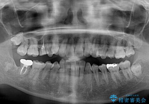 目立つ八重歯を改善　ワイヤー装置での抜歯矯正の治療前