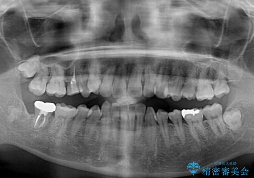 目立つ八重歯を改善 ワイヤー装置での抜歯矯正の治療前