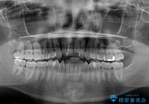 オープンバイトをインビザラインで矯正治療の治療前