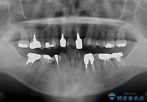 非対称の前歯を整えたい 矯正治療と審美治療の総合歯科診療の治療前