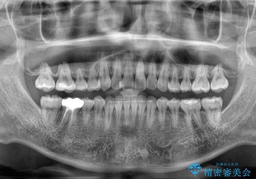 前歯のデコボコと突出感をマウスピース矯正できれいにの治療後