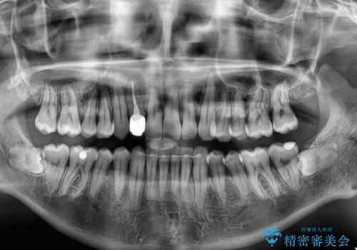 前歯のデコボコを治したい　インビザラインによる矯正治療の治療後