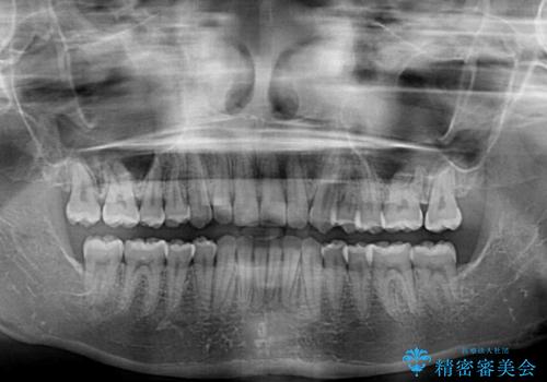 ディープバイトを短期間で改善　ワイヤー矯正治療の治療後