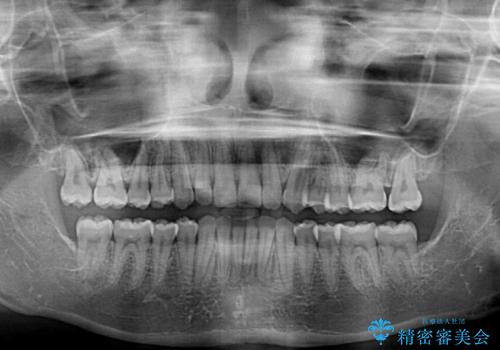 ディープバイトを短期間で改善 ワイヤー矯正治療の治療後