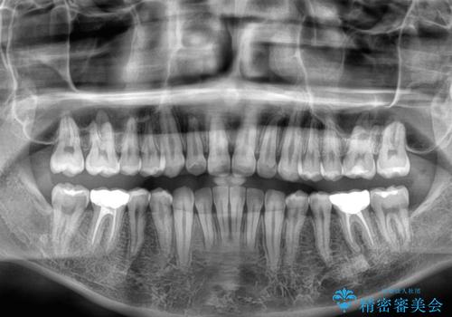 楽してデコボコを治したい　ワイヤー矯正治療の治療後
