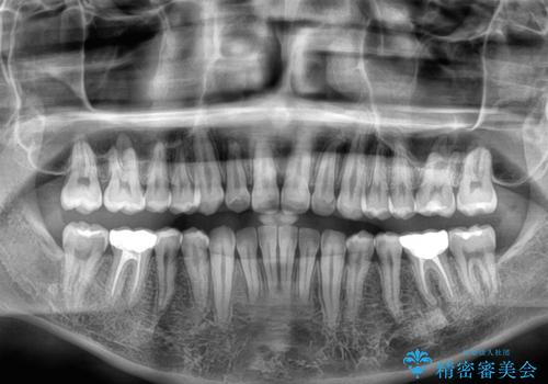 楽してデコボコを治したい ワイヤー矯正治療の治療後