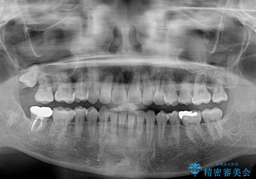 目立つ八重歯を改善　ワイヤー装置での抜歯矯正の治療後