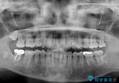 目立つ八重歯を改善 ワイヤー装置での抜歯矯正の治療後