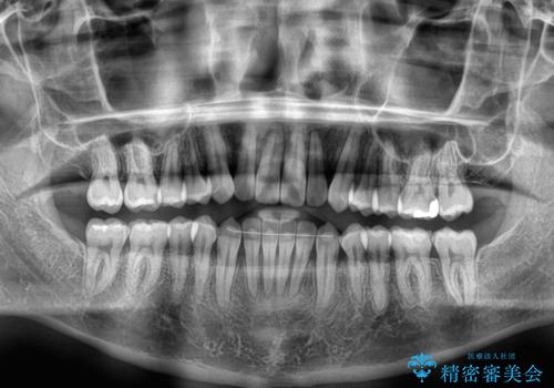 オープンバイトをインビザラインで矯正治療の治療後