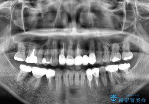 非対称の前歯を整えたい 矯正治療と審美治療の総合歯科診療の治療後