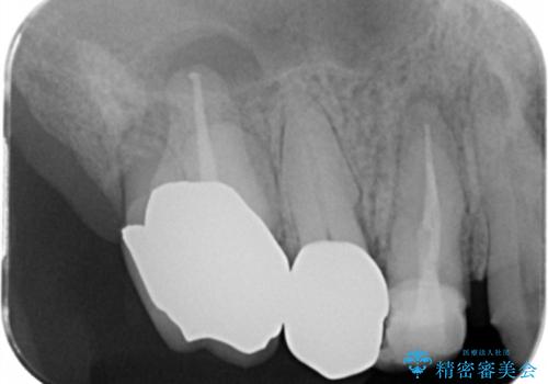 咬合の崩壊 金属床義歯で咬合機能の回復の治療前
