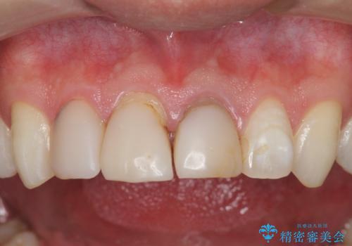 前歯の変色 審美性の改善の治療前