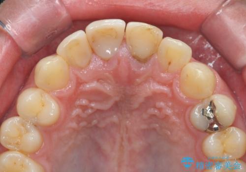 前歯の変色 審美性の改善の治療前