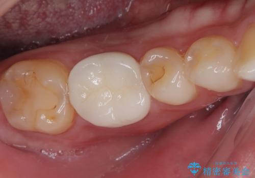 セラミックの詰め物が欠けたのでやり替えたい　オールセラミッククラウンの症例 治療後