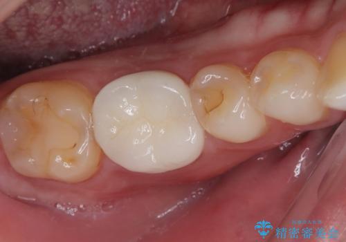 セラミックの詰め物が欠けたのでやり替えたい オールセラミッククラウンの症例 治療後