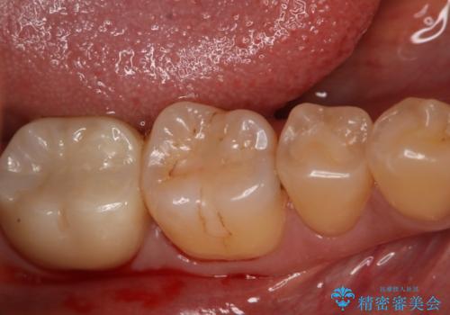 奥歯にセラミックを入れたいの治療前