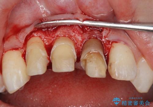 前歯の変色 審美性の改善の治療中