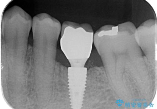 奥歯の欠損　インプラント治療の治療後