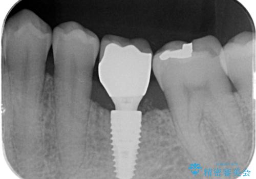 奥歯の欠損 インプラント治療の治療後