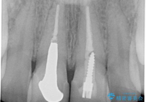 前歯を綺麗にしたい　e-maxクラウンでの修復の治療後