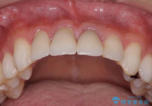 前歯の変色 審美性の改善の治療後