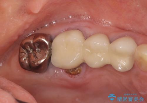 過大な咬合力で破折した奥歯 インプラント治療で咬合機能の回復の治療前