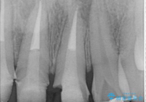 前歯の変色 審美性の改善の治療中