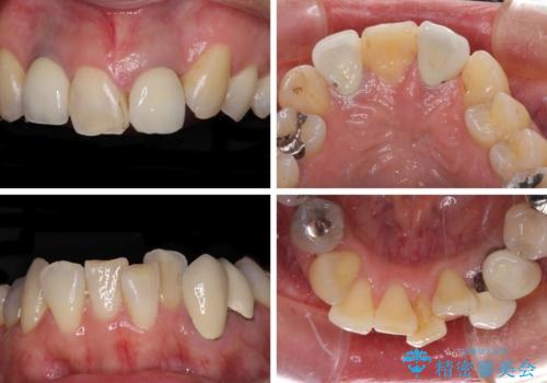 非対称の前歯を整えたい　矯正治療と審美治療の総合歯科診療の治療前