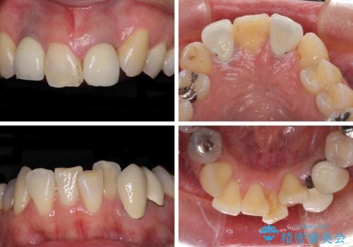 非対称の前歯を整えたい 矯正治療と審美治療の総合歯科診療の治療前