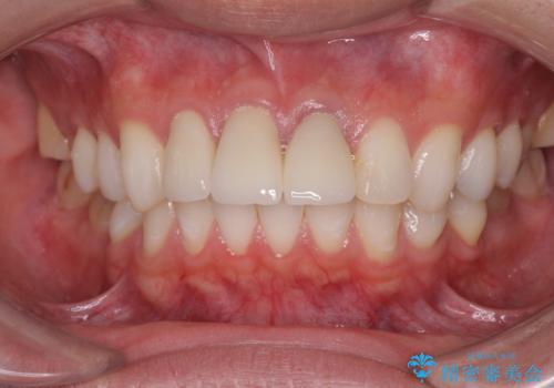 前歯の変色 審美性の改善の治療後