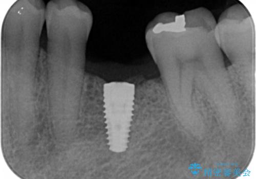 奥歯の欠損　インプラント治療の治療中