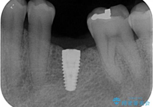 奥歯の欠損 インプラント治療の治療中