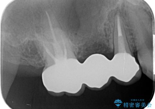 割れてしまった奥歯　セラミックブリッジ治療の治療後