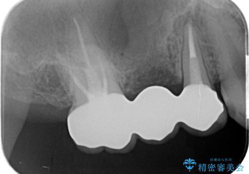 割れてしまった奥歯 セラミックブリッジ治療の治療後