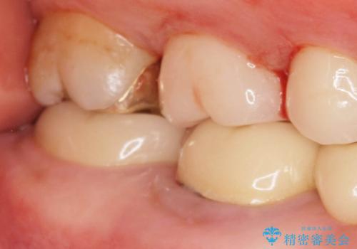 インレー下に再発した虫歯 セラミッククラウンによるやり替えの治療後