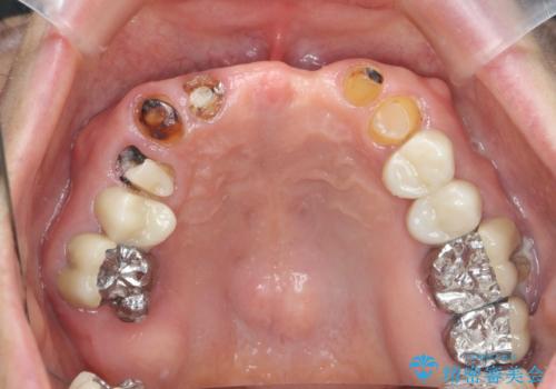 咬合の崩壊 金属床義歯で咬合機能の回復の症例 治療前