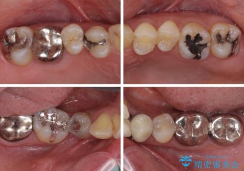 非対称の前歯を整えたい 矯正治療と審美治療の総合歯科診療の治療前