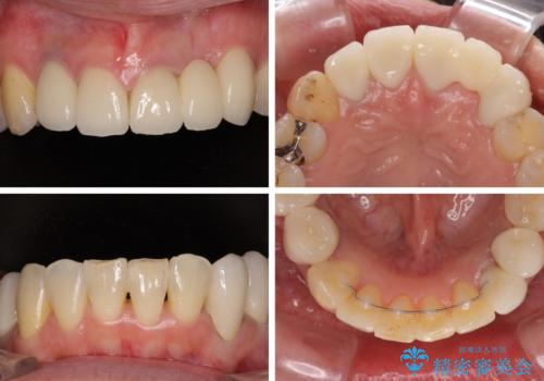 非対称の前歯を整えたい　矯正治療と審美治療の総合歯科診療の治療後
