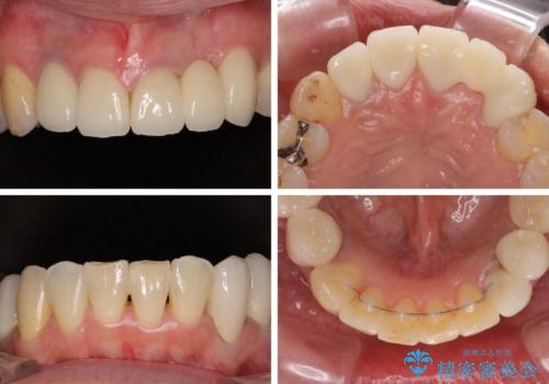 非対称の前歯を整えたい 矯正治療と審美治療の総合歯科診療の治療後