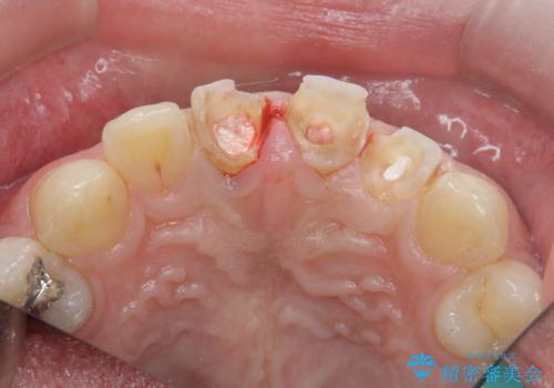 前歯の変色 審美性の改善の治療前