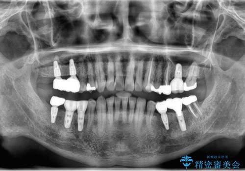歯が割れているといわれた 奥歯にインプラントをしていきたい 全体的な治療の治療後