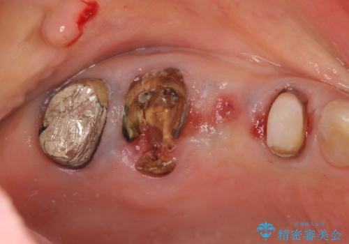 過大な咬合力で破折した奥歯　インプラント治療で咬合機能の回復の治療前