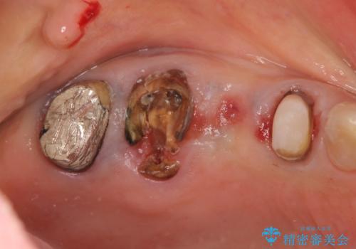過大な咬合力で破折した奥歯 インプラント治療で咬合機能の回復の治療前